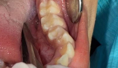 بعد علاج الأسنان